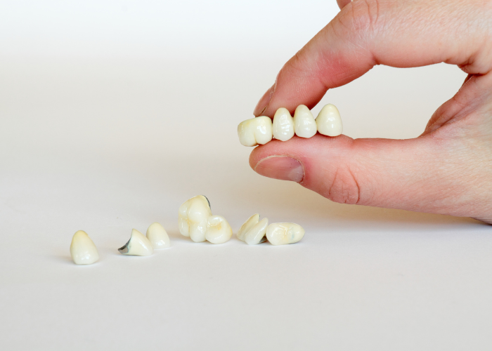 Dental Bridge Boca Raton