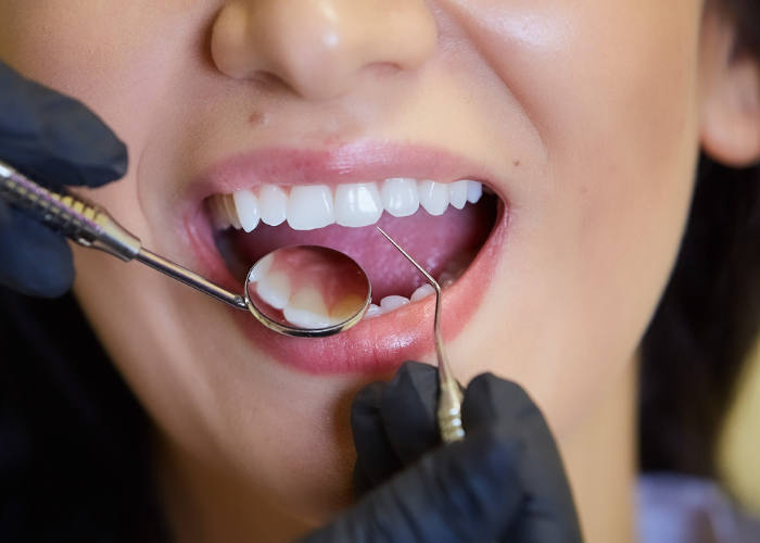 Teeth Cleanings Boca Raton