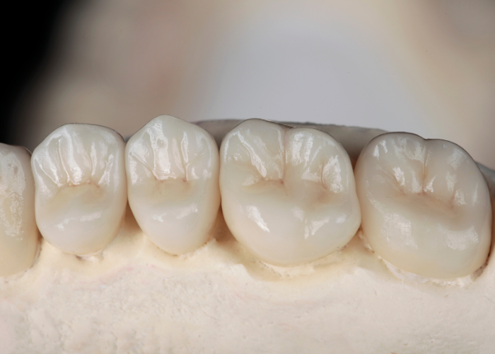 Dental Crown Boca Raton