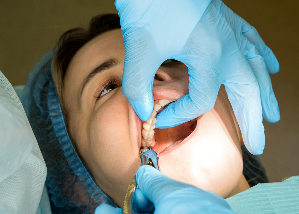 tooth extraction Boca Raton