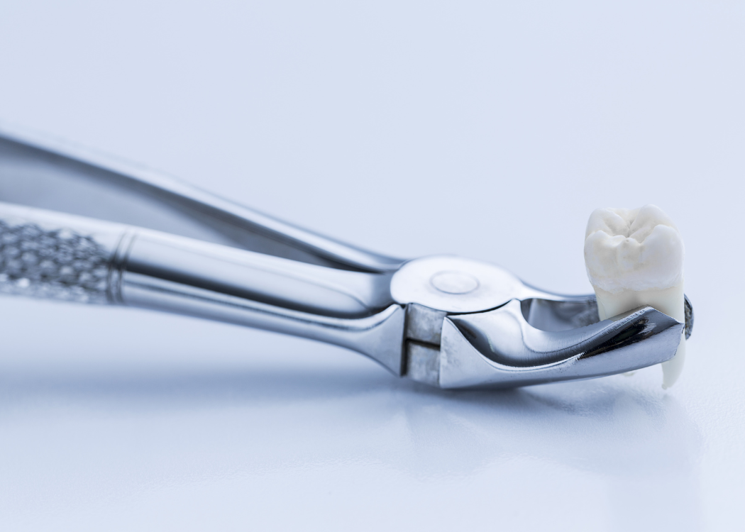 tooth extraction Boca Raton