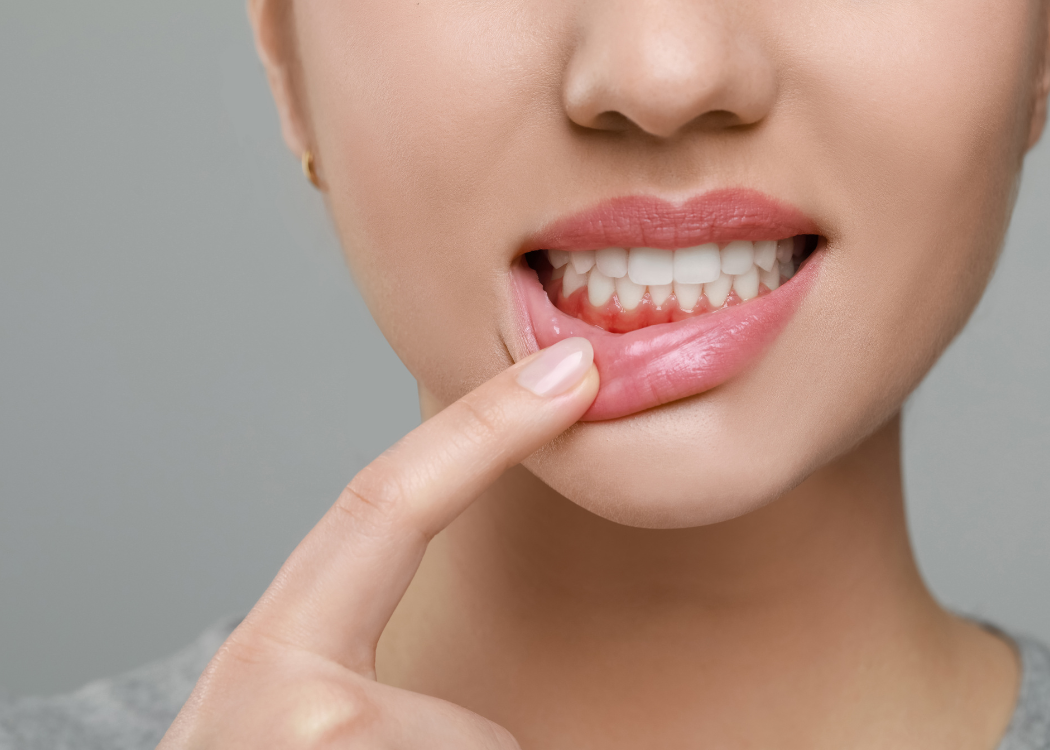 Gum Disease Boca Raton