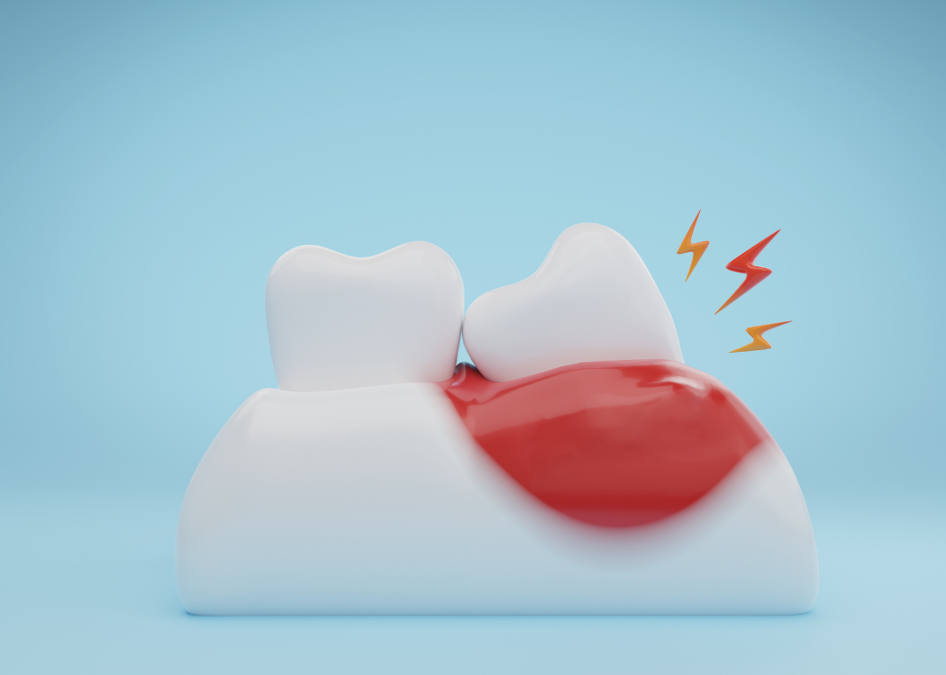 Periodontal Disease in Boca Raton