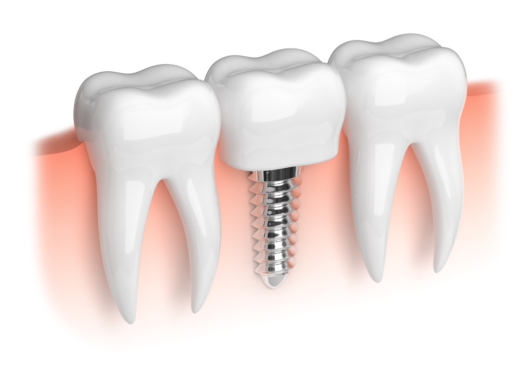 Dental Implants Boca Raton