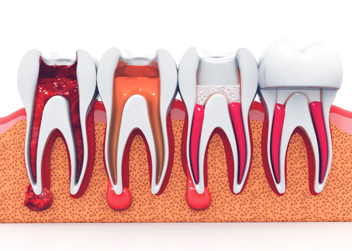 Endodontics Treatment Boca Raton FL