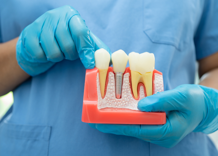 Root Canal in Boca Raton