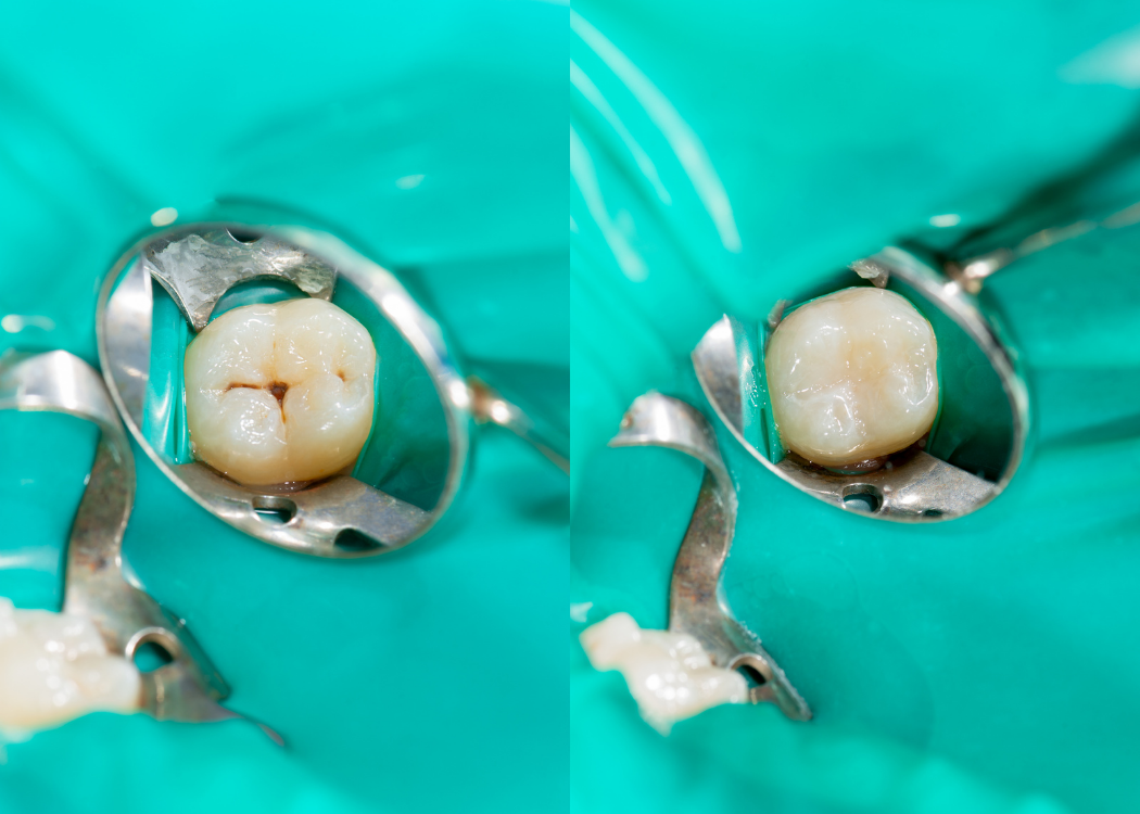 Affordable Dental Sealants Boca Raton, FL