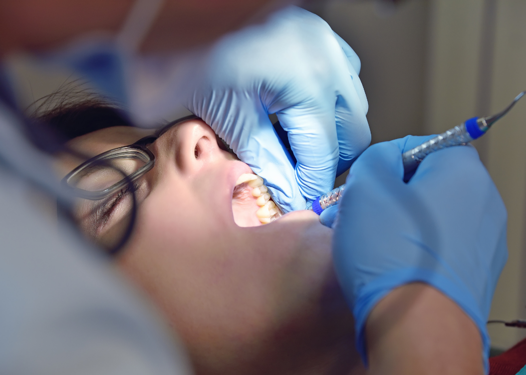 Dental Sealant Treatment Boca Raton