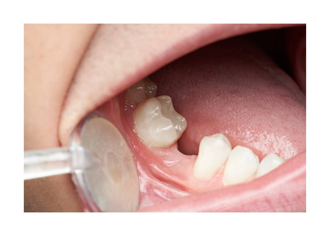 single tooth replacement Boca Raton FL