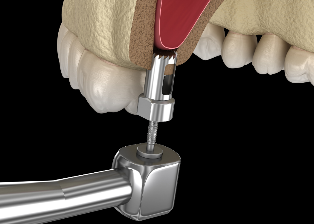 Sinus Lift Surgery