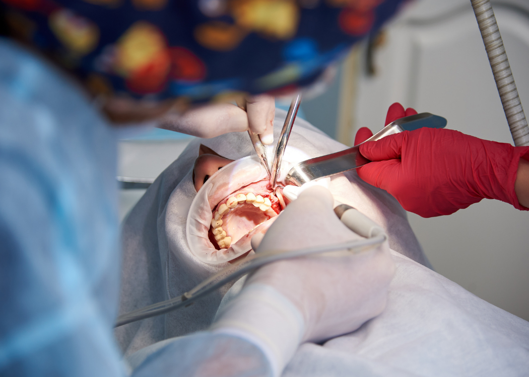 Sinus Lift Surgery