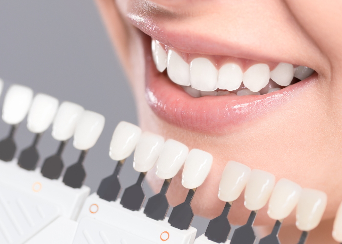  Teeth Whitening Treatment Boca Raton FL