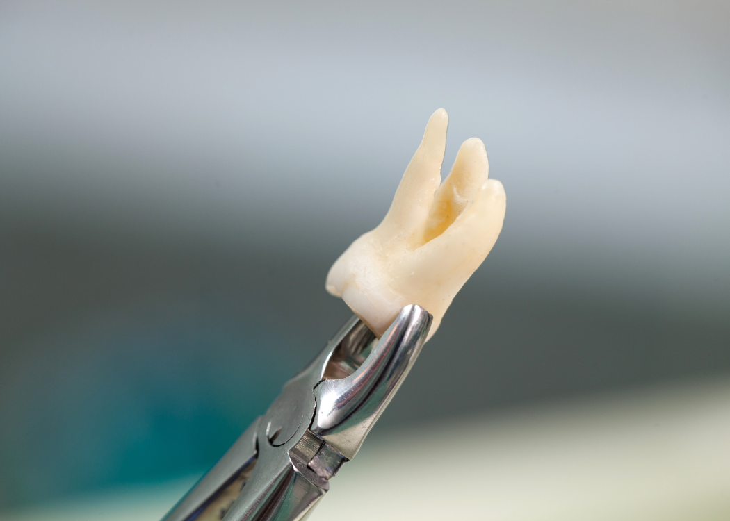 wisdom teeth extraction Boca Raton FL